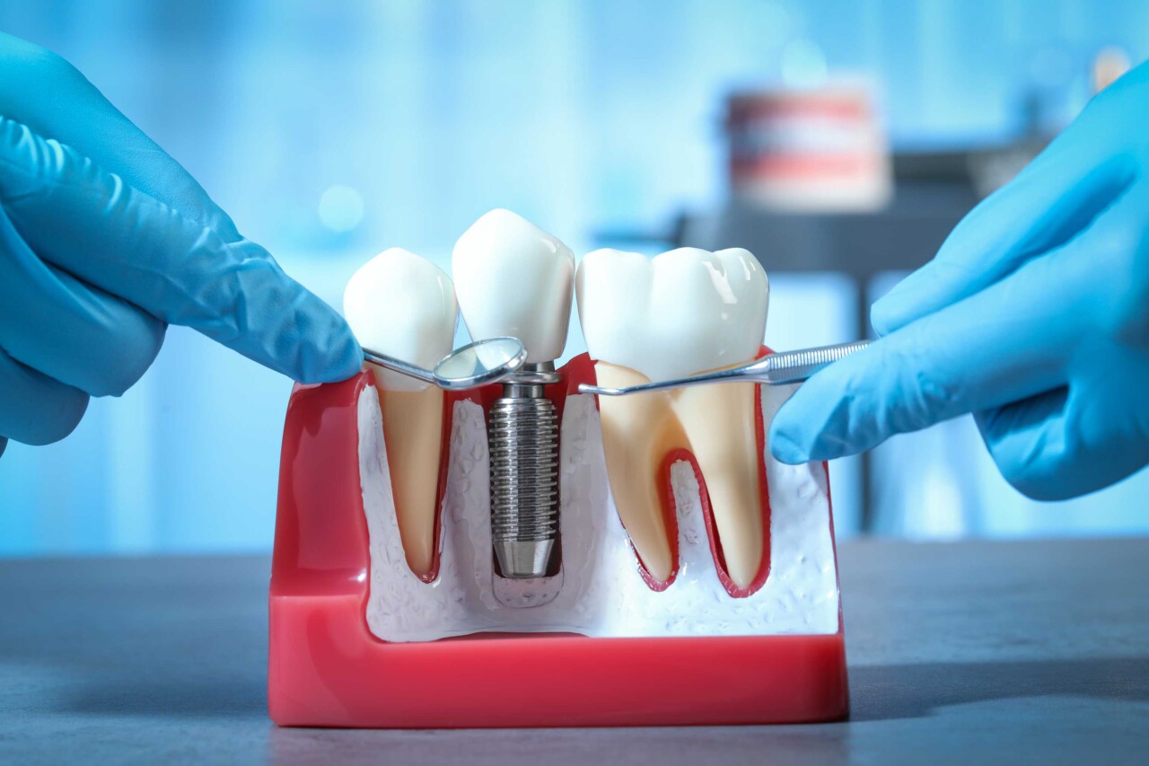 Diş implantının ömrü ne kadardır?