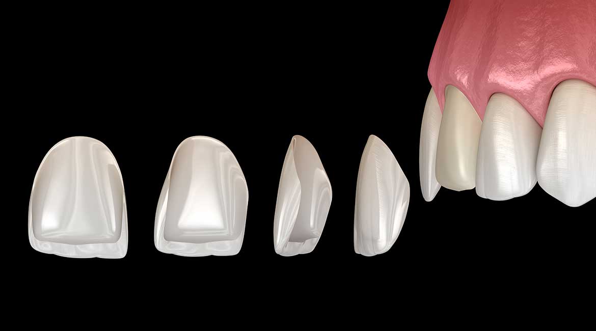 Lamine Diş Kaplaması Nedir?